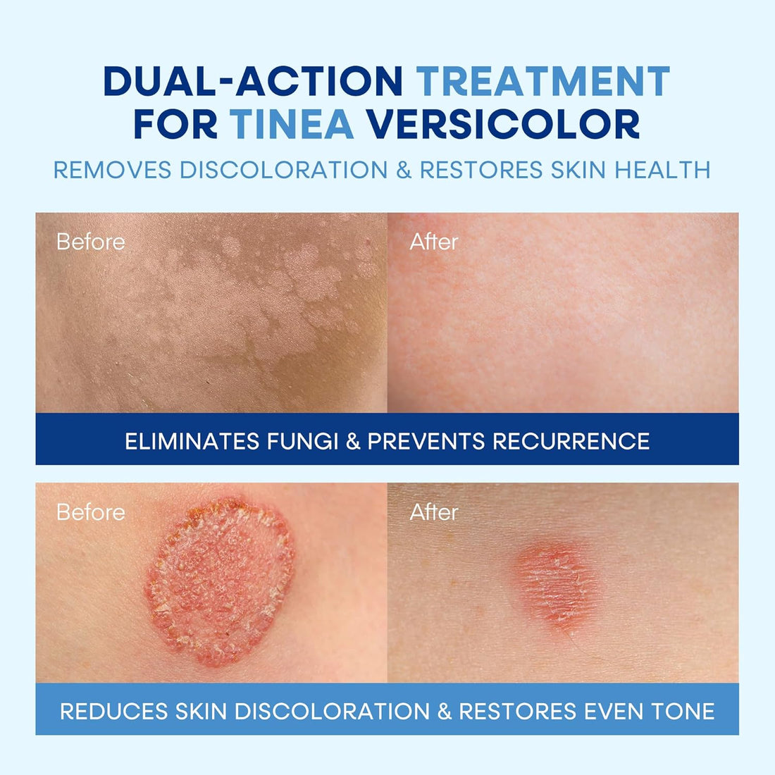Tinea Versicolor Treatment Cream & Soap