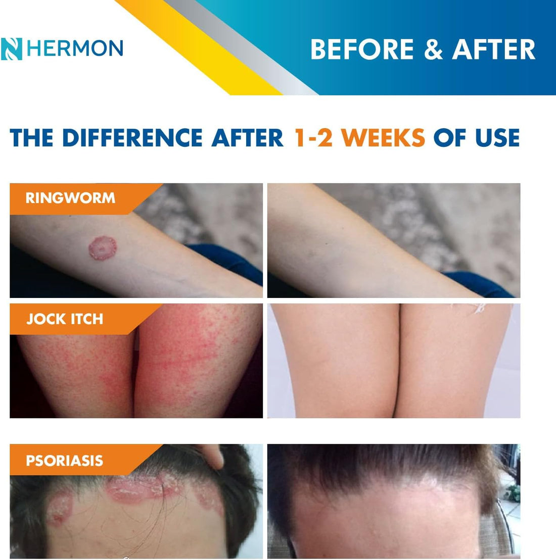 Ringworm treatment cream