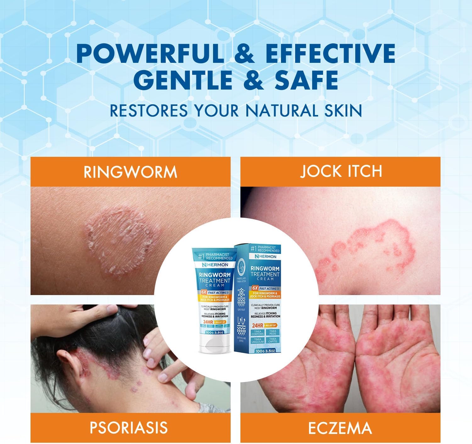 Ringworm Treatment Cream Hermon Ringworm Treatment Cream Hermon