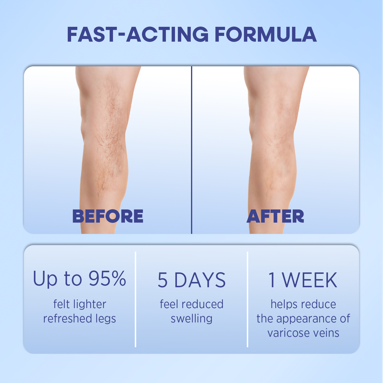 Varicose Veins Cream