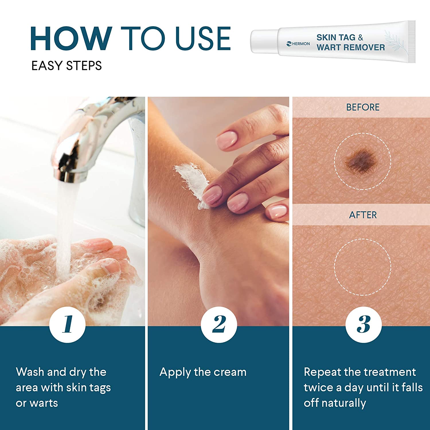 best skin tag remover for sensitive areas